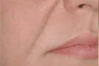 Sillons profonds