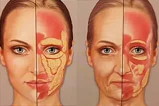 La perte de tonicité des muscles faciaux