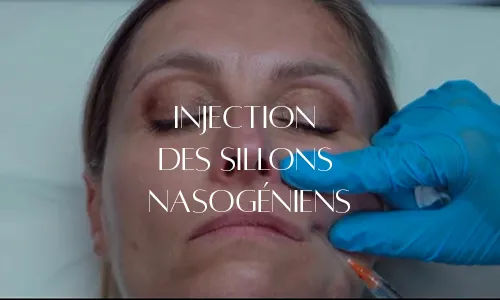SILLONS NASOGÉNIENS