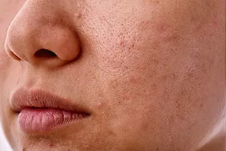 Cicatrices d'Acné - TRAITEMENT DES CICATRICES D'ACNÉ À PARIS — MICRONEEDLING ET RADIOFRÉQUENCE - Médecine esthétique à Paris 12
