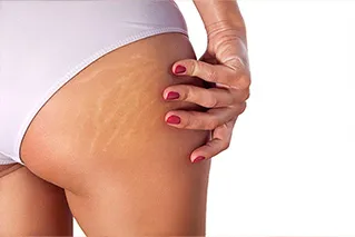 MICRONEEDLING