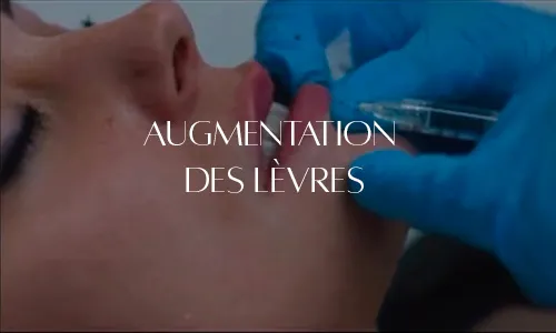 Augmentation des lèvres